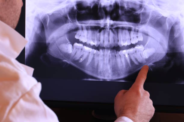 Best Emergency Dentist for Lost Fillings or Crowns in Lmerton, PA