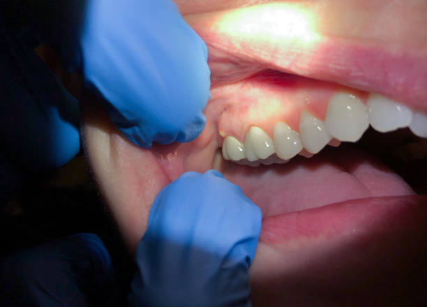 Best Emergency Dental Extractions in Lmerton, PA